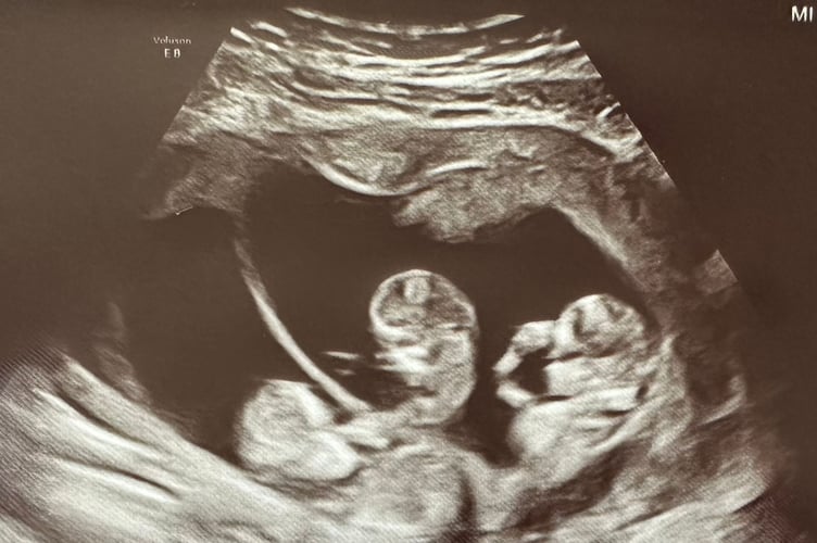 An Ultrasound of the triplets. See SWNS story SWSMtriplets. Meet the miracle triplets who arrived home in time for Christmas - after arriving eight weeks early and spending five weeks in hospital. Little Emil, Ava, and Alba Wise, now 6 weeks, were able to finally leave the Queen Alexandra Hospital, Portsmouth after arriving at 32 weeks on November 1. Their proud parents Hannah Gurney, 36, and her partner, Chris Wise, 38, a sports broadcaster, had planned to have a c-section at 34 weeks but Hannah went into labour a fortnight early. Ten hours later, they welcomed Emil, Ava, and Alba - weighing 3lbs 3oz, 3lbs 2oz and 3lbs 1.5oz respectively.