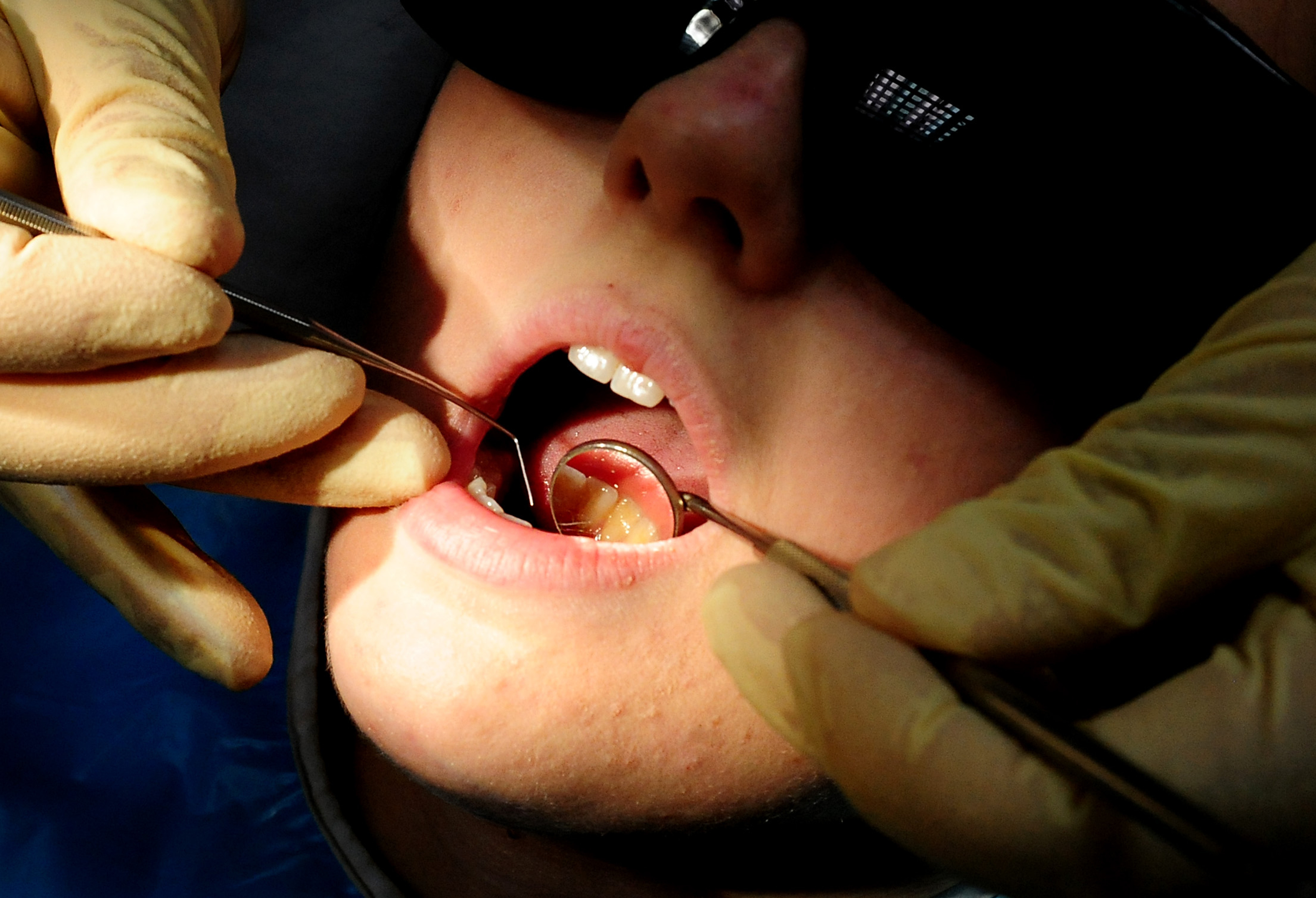 Dozens of hospital admissions in Waverley to remove children's rotten teeth