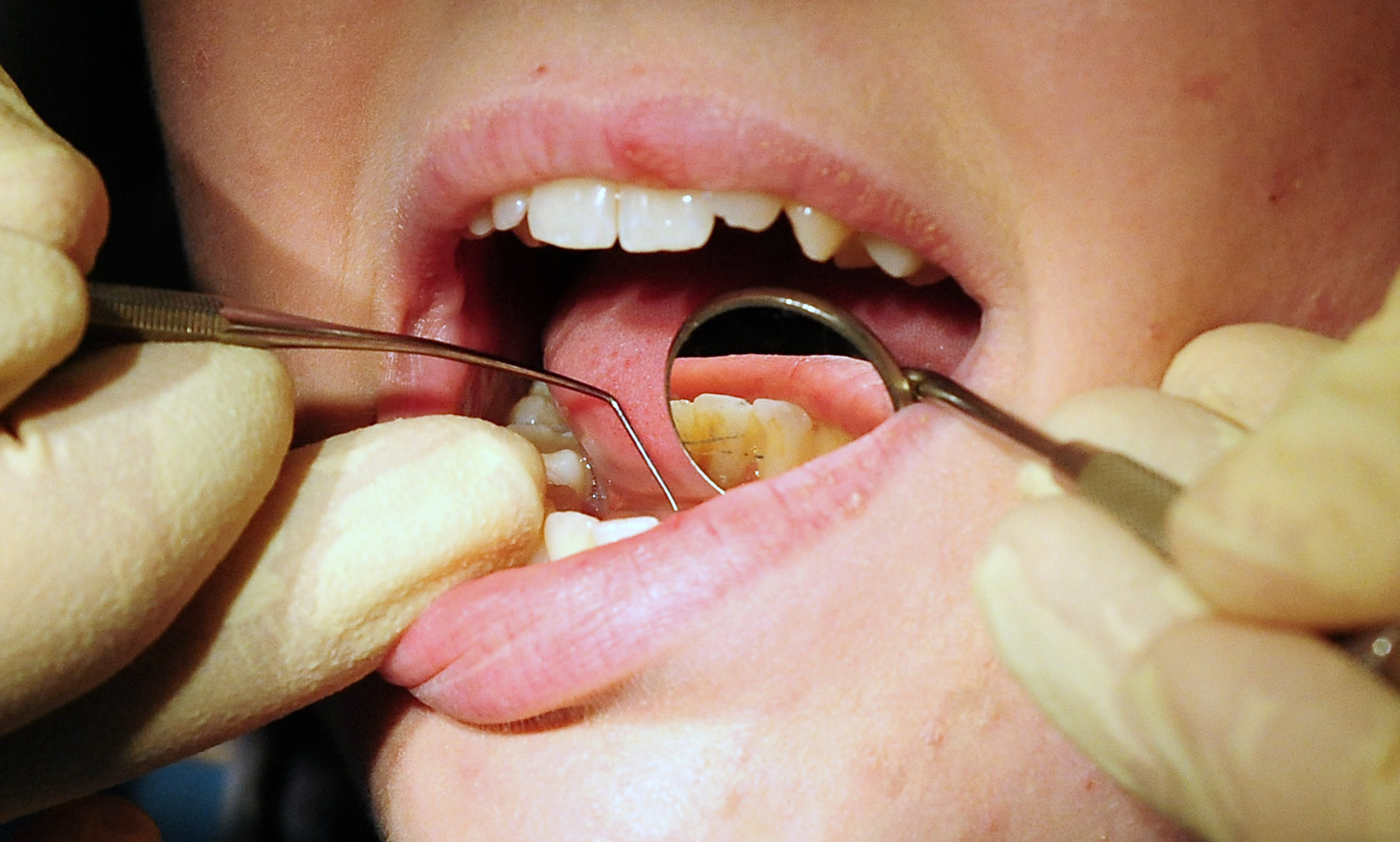 Nearly a quarter of people in the Surrey heartlands struggle to get an NHS dentist appointment