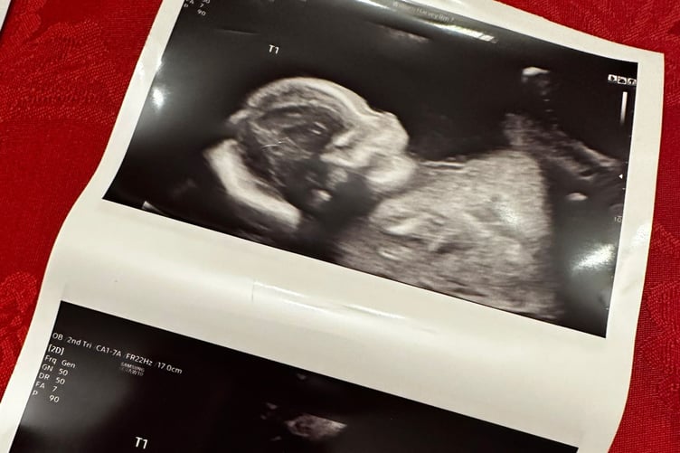 Lauren and Hannah's baby scan for their triplet girls. Release date January 24 2025. A couple who are constantly mistaken for mother and son flew to Cyprus so they could afford IVF - and are now expecting triplets. Lauren Kaye, 31, and her wife, Hannah, 29, knew they wanted to start a family but were shocked after being quoted £21k for fertility treatment in the UK. Instead they looked at going abroad but had to tie the knot first so Hannah, a specialist engineer, wouldn't have to adopt her own baby. The couple planned their wedding in just six weeks and got married in August 2024 before jetting off to Cyprus the following month for treatment - costing £9k. Lauren had Hannah's fertilised eggs implanted in her womb and found out she was pregnant three days later. The pair - who often get mistaken for mother and son due to Hannah's youthful appearance - were shocked to discover they were expecting triplet girls.