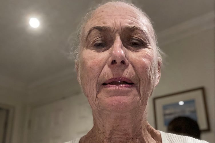 Catriona Tremlett after having chemotherapy.