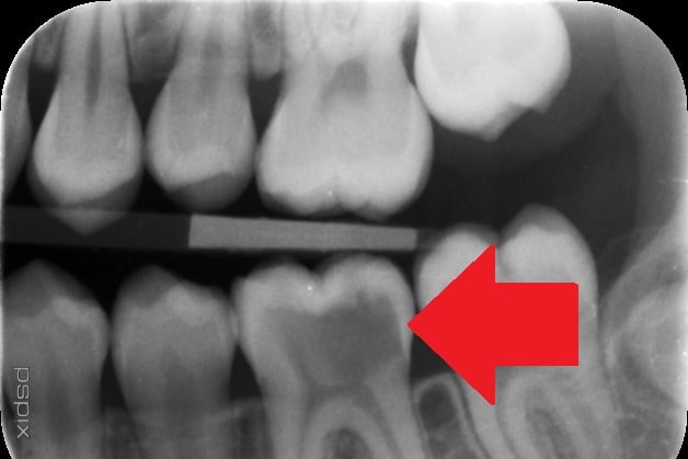 Decayed lower left first molar