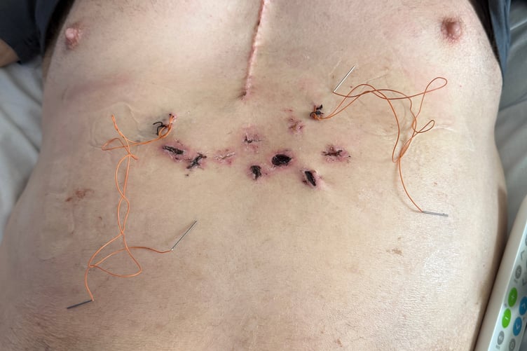 The scars on Mike Stamp's chest.